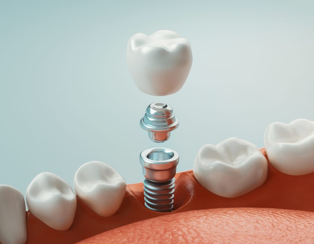 Why Dental Implants Are a Long-Term Solution for Missing Teeth 3 Portland Oral and Facial Surgery dental-implants-portland