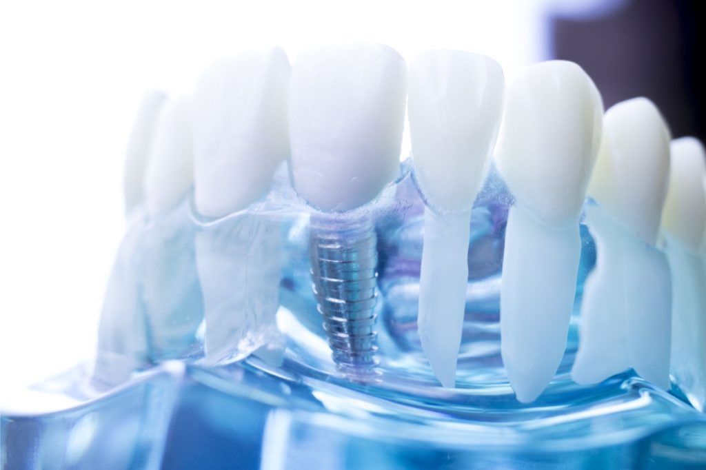 The "Silent" Success: Why the best dental implants are the ones you (and others) never notice. 1 Portland Oral and Facial Surgery dental implantsoral surgeon Portland Oral and Facial Surgery